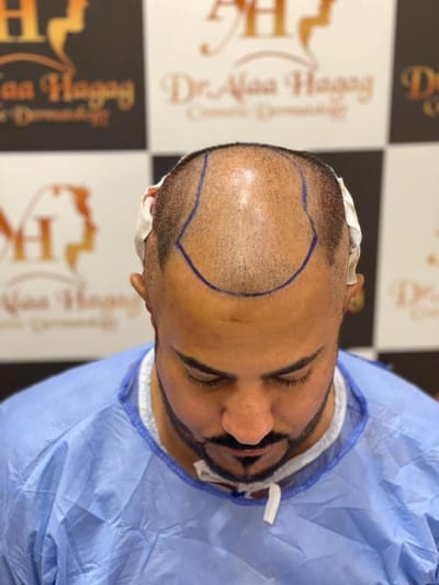 زراعة الشعر