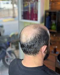 Kişiye Özel Protez Saç