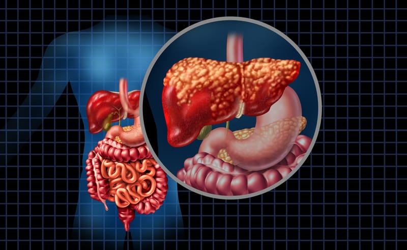 Fatty Liver & Liver Damage