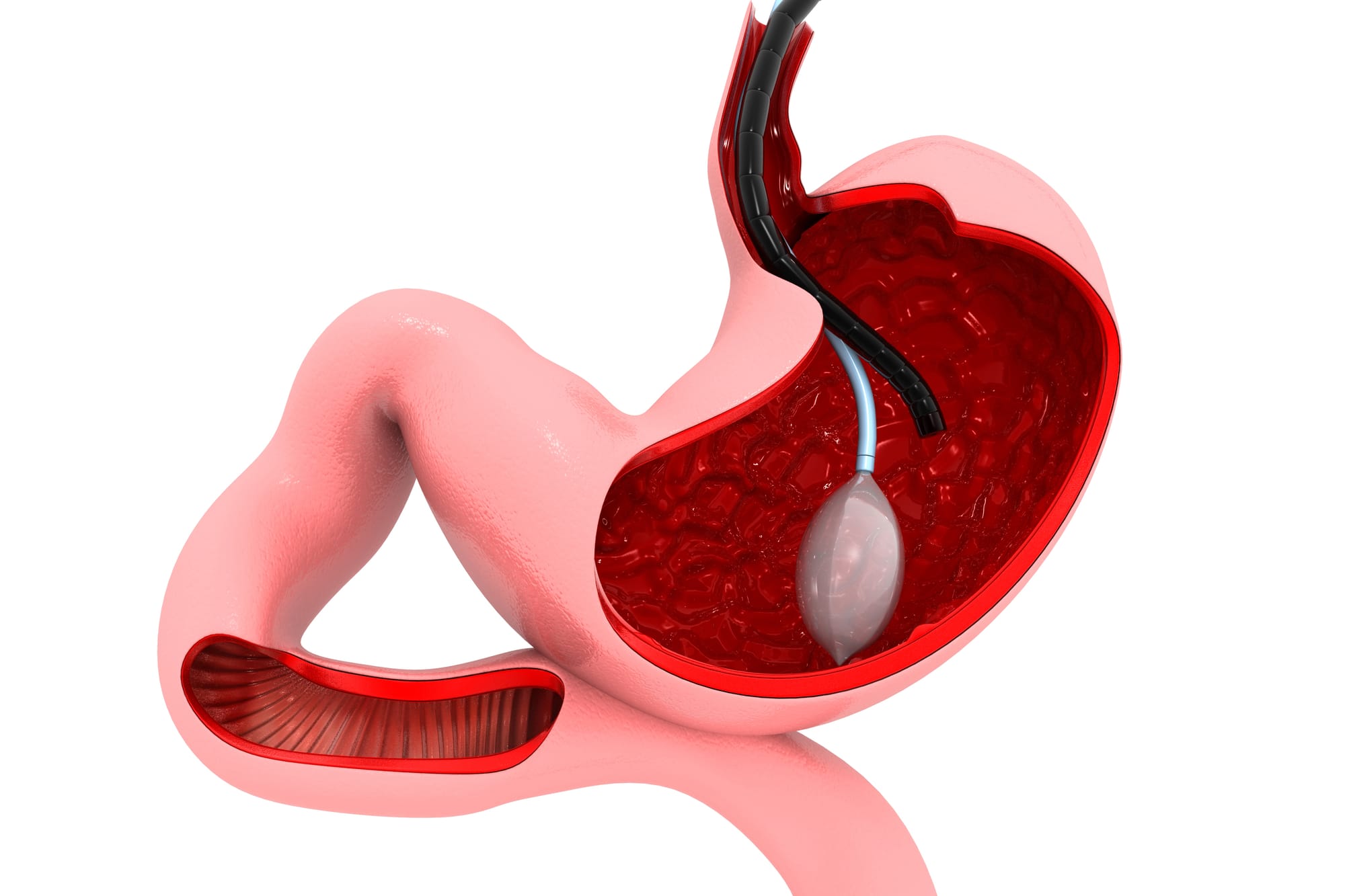 ⚖️ Smart Gastric Balloon vs Classic Balloon vs Sleeve Gastrectomy: Which Is Best for You?
