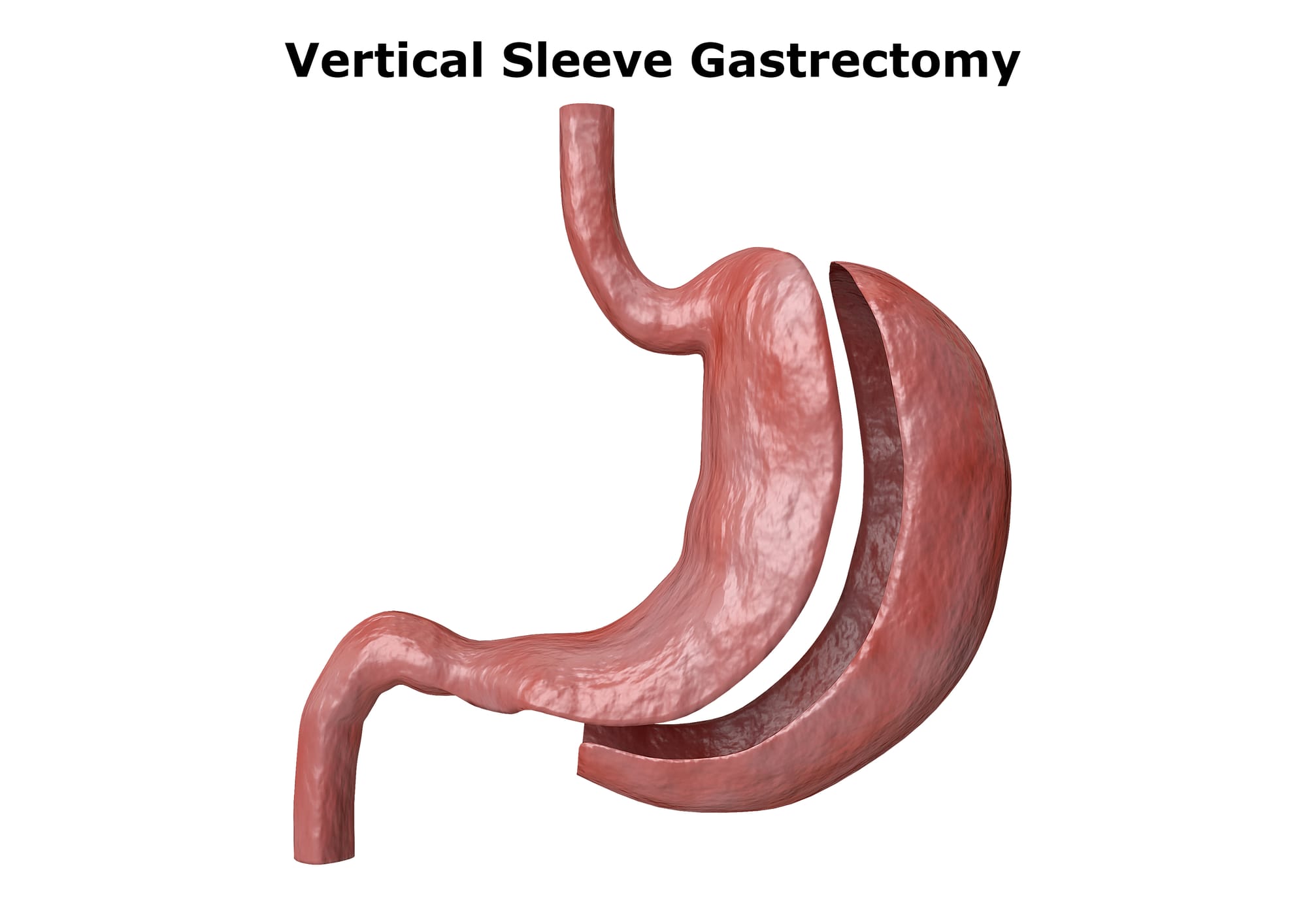 Gastric Sleeve Surgery in Istanbul: A Comprehensive Guide