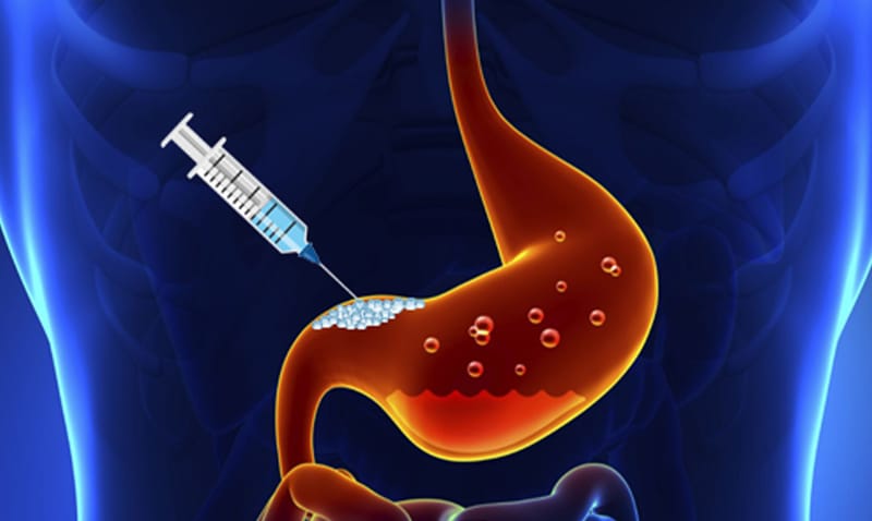 Gastric Botox