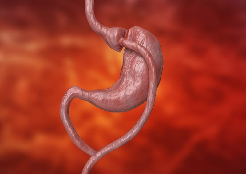 Gastric Bypass