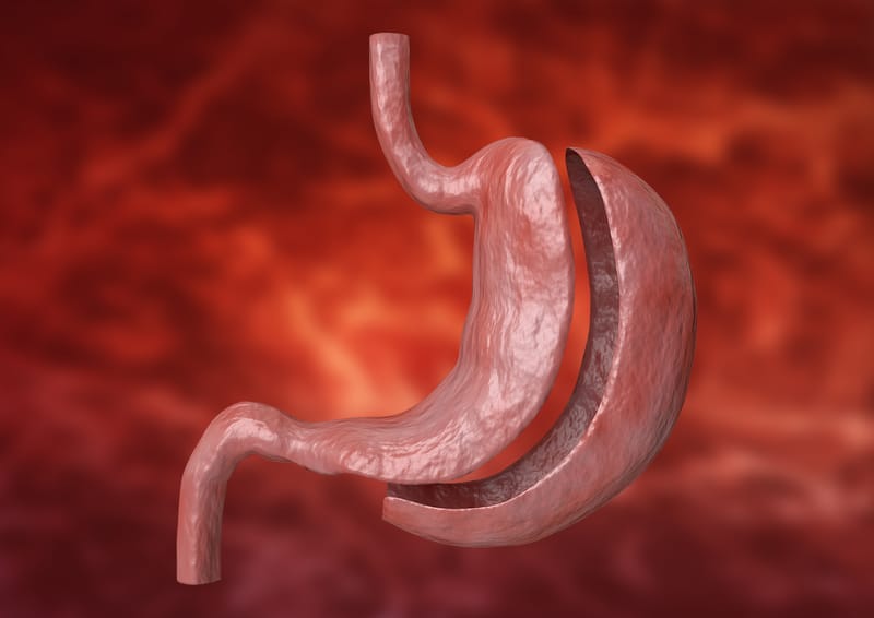 Gastric Sleeve
