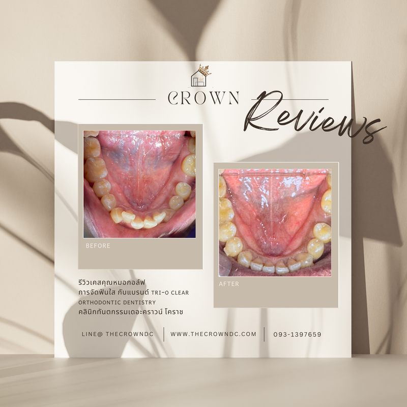 รีวิวการรักษาเคสจัดฟัน(บางส่วน)