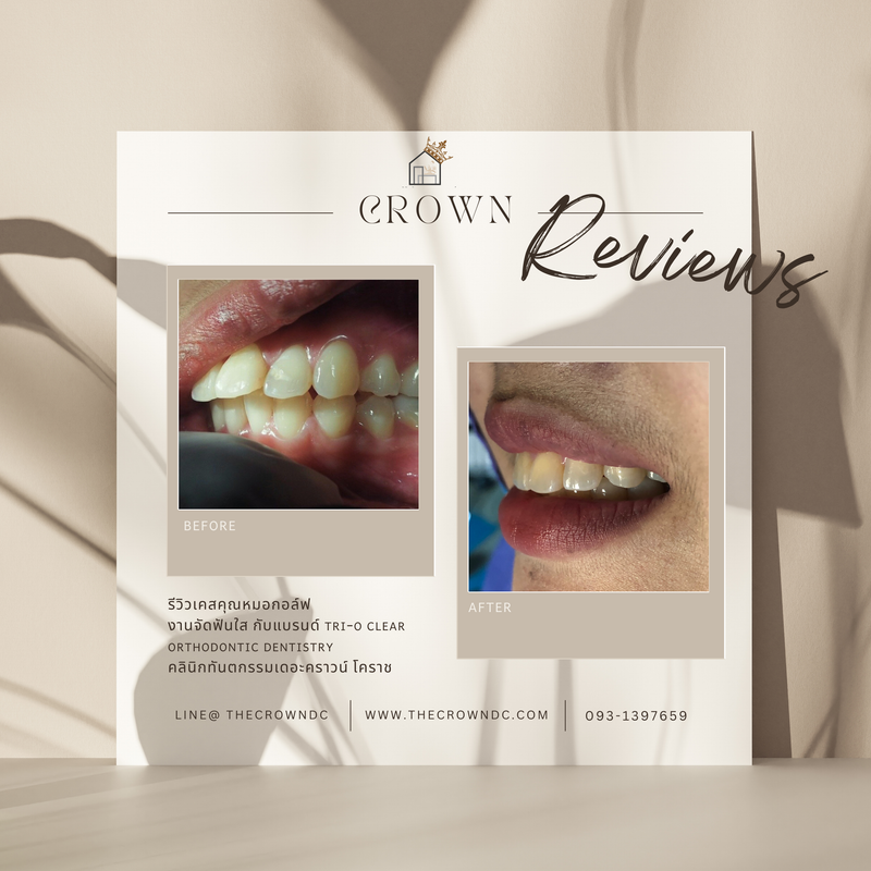 รีวิวการรักษาเคสจัดฟัน(บางส่วน)