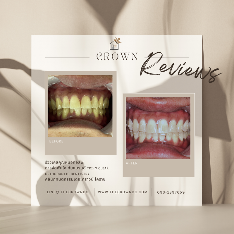 รีวิวการรักษาเคสจัดฟัน(บางส่วน)