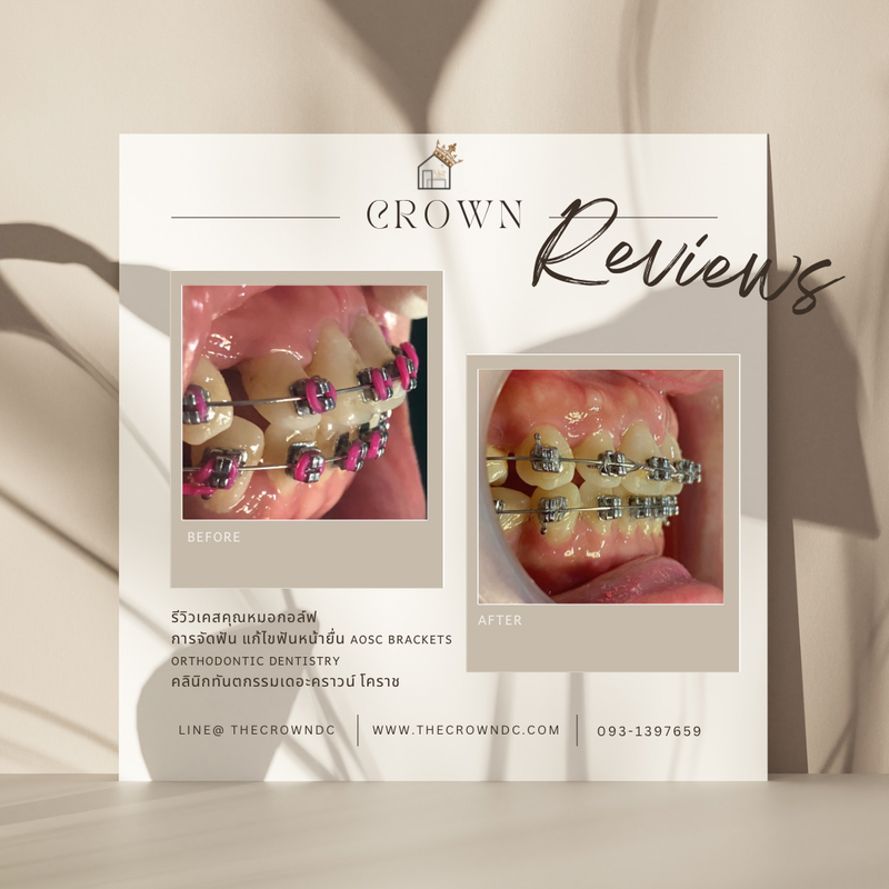 รีวิวการรักษาเคสจัดฟัน(บางส่วน)