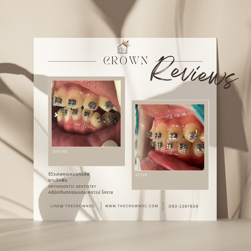 รีวิวการรักษาเคสจัดฟัน(บางส่วน)