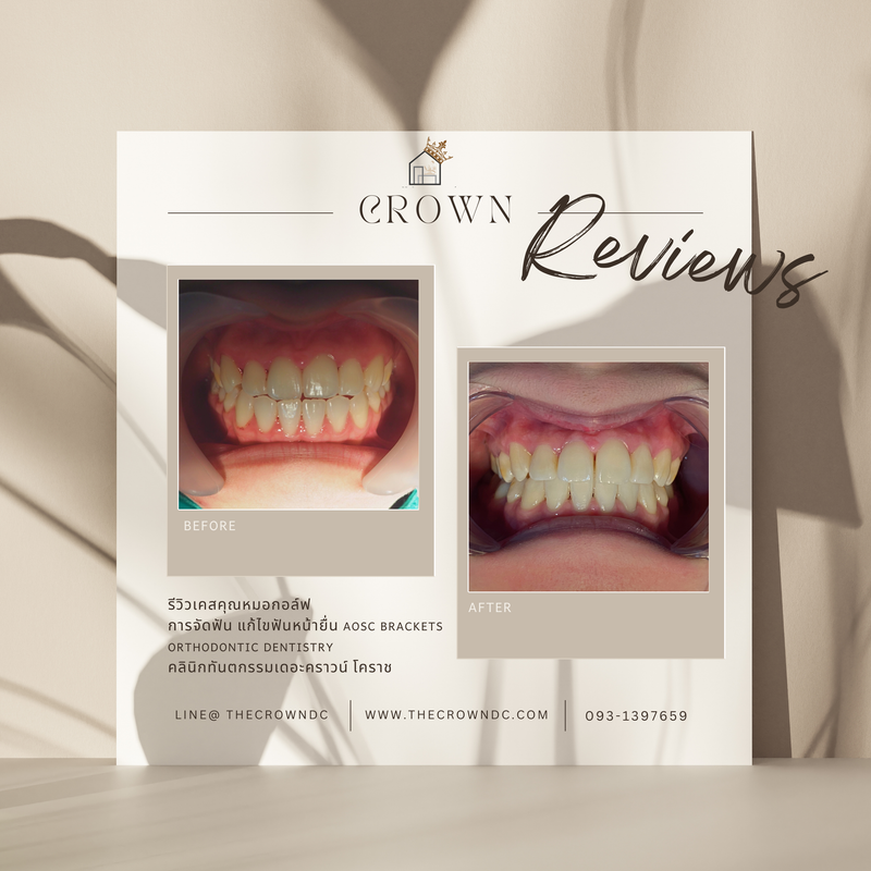 รีวิวการรักษาเคสจัดฟัน(บางส่วน)