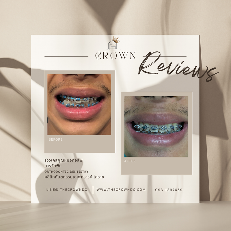 รีวิวการรักษาเคสจัดฟัน(บางส่วน)