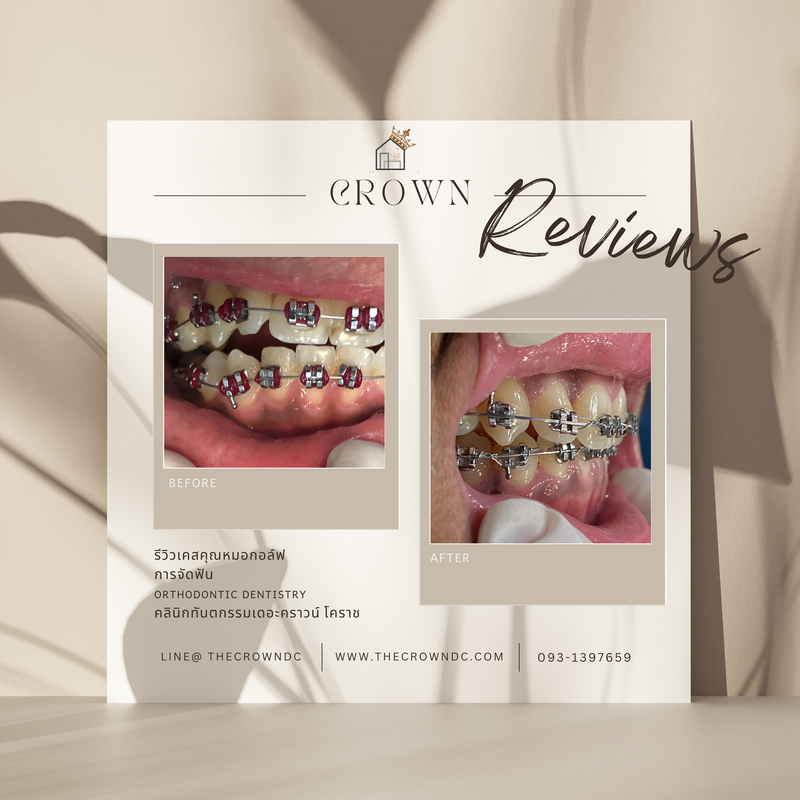 รีวิวการรักษาเคสจัดฟัน(บางส่วน)