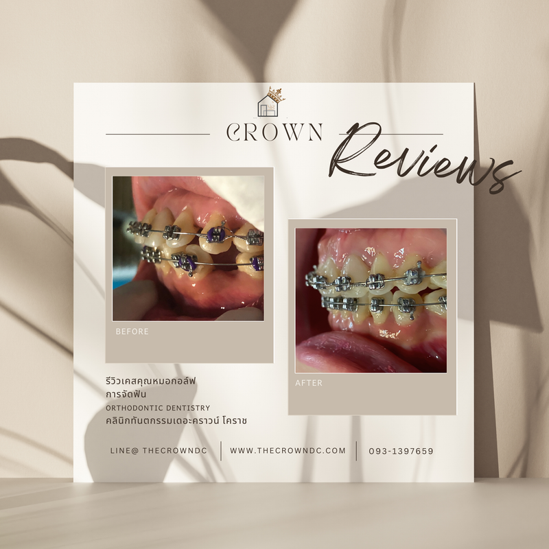 รีวิวการรักษาเคสจัดฟัน(บางส่วน)