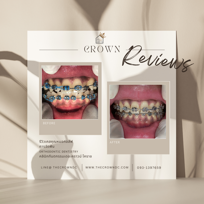 รีวิวการรักษาเคสจัดฟัน(บางส่วน)