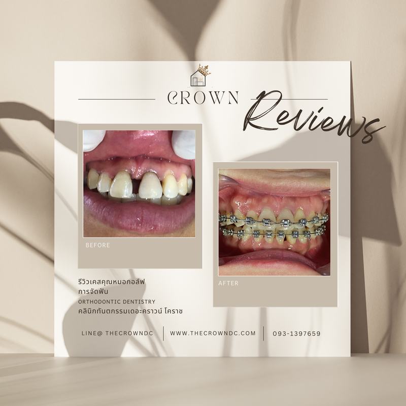 รีวิวการรักษาเคสจัดฟัน(บางส่วน)