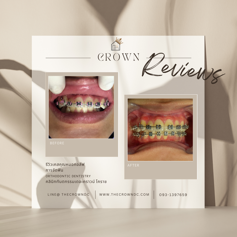 รีวิวการรักษาเคสจัดฟัน(บางส่วน)