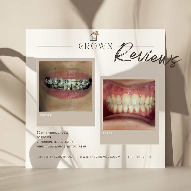 รีวิวการรักษาเคสจัดฟัน(บางส่วน)