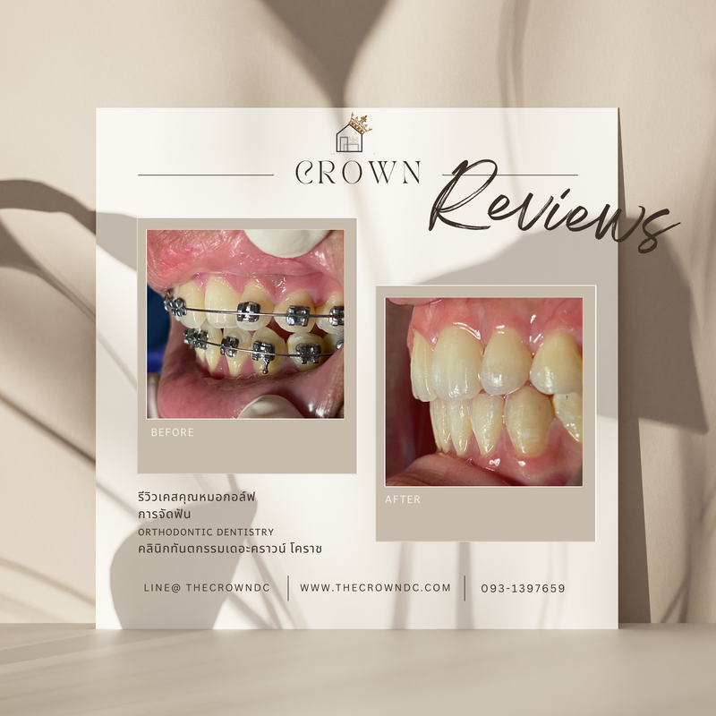 รีวิวการรักษาเคสจัดฟัน(บางส่วน)