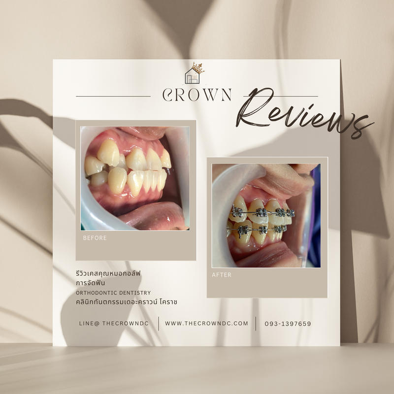 รีวิวการรักษาเคสจัดฟัน(บางส่วน)