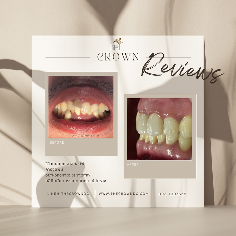 รีวิวการรักษาเคสจัดฟัน(บางส่วน)