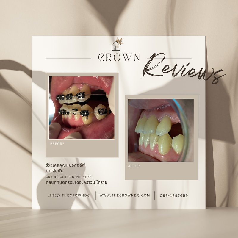 รีวิวการรักษาเคสจัดฟัน(บางส่วน)