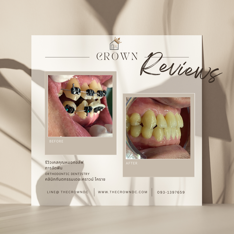 รีวิวการรักษาเคสจัดฟัน(บางส่วน)