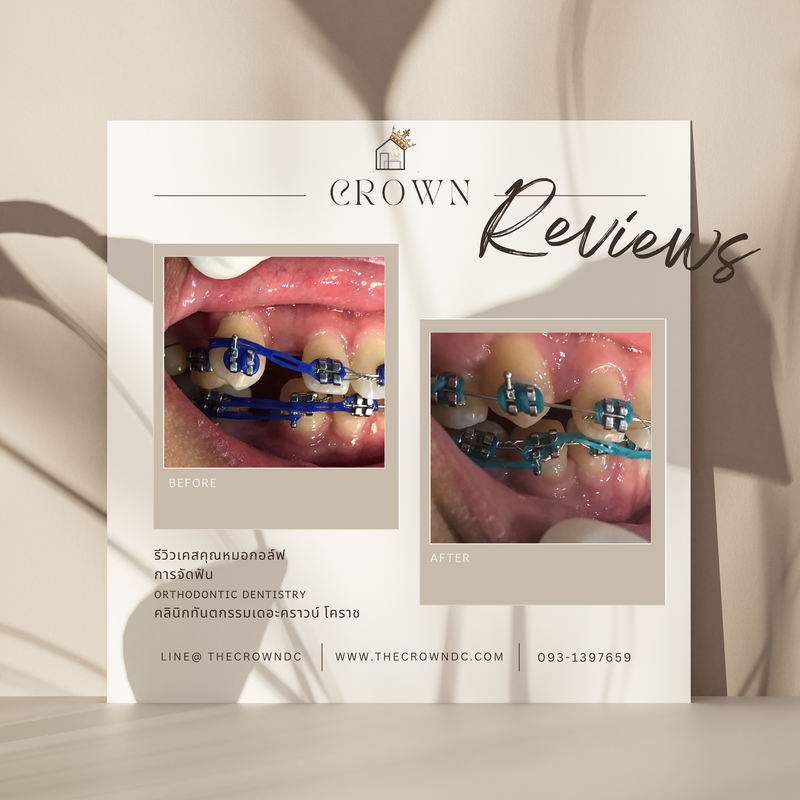 รีวิวการรักษาเคสจัดฟัน(บางส่วน)
