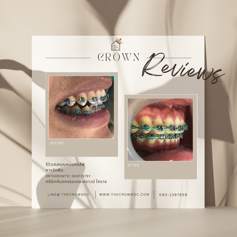 รีวิวการรักษาเคสจัดฟัน(บางส่วน)