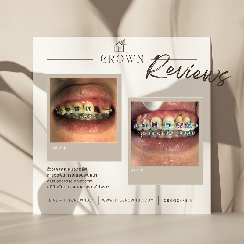 รีวิวการรักษาเคสจัดฟัน(บางส่วน)