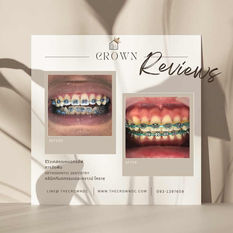 รีวิวการรักษาเคสจัดฟัน(บางส่วน)