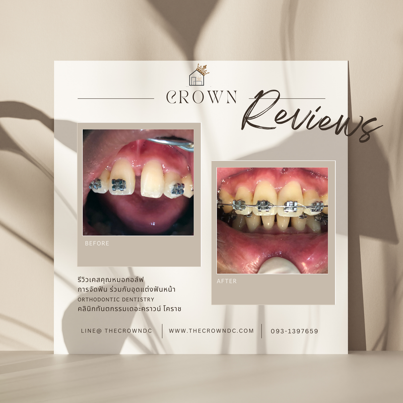 รีวิวการรักษาเคสจัดฟัน(บางส่วน)