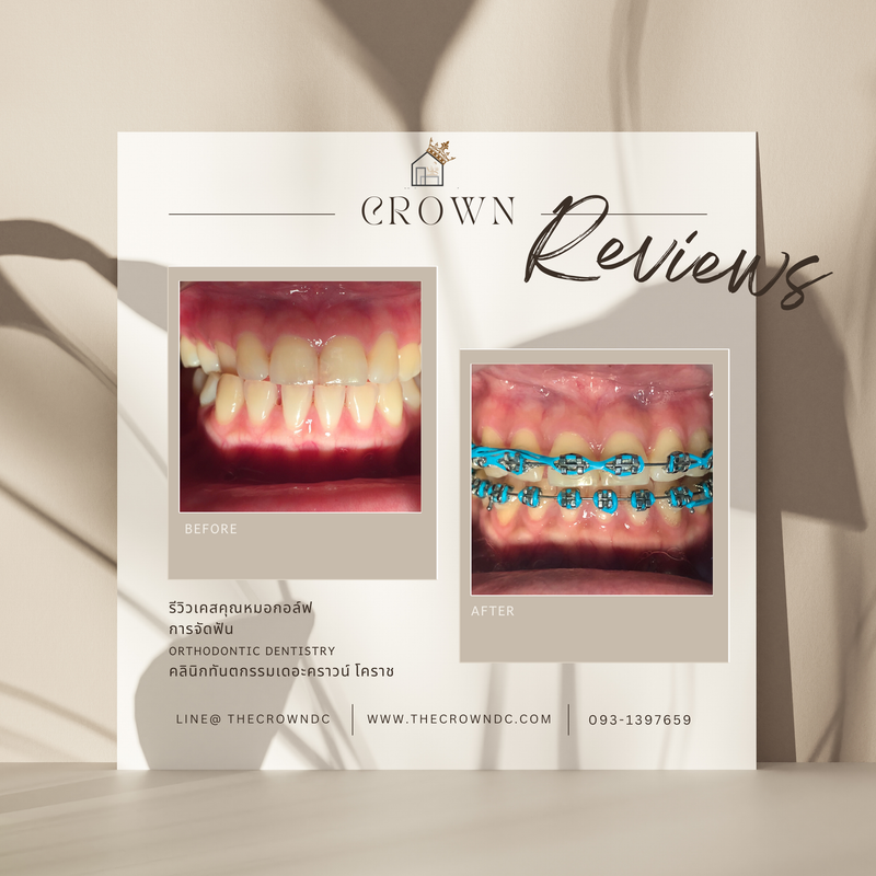 รีวิวการรักษาเคสจัดฟัน(บางส่วน)