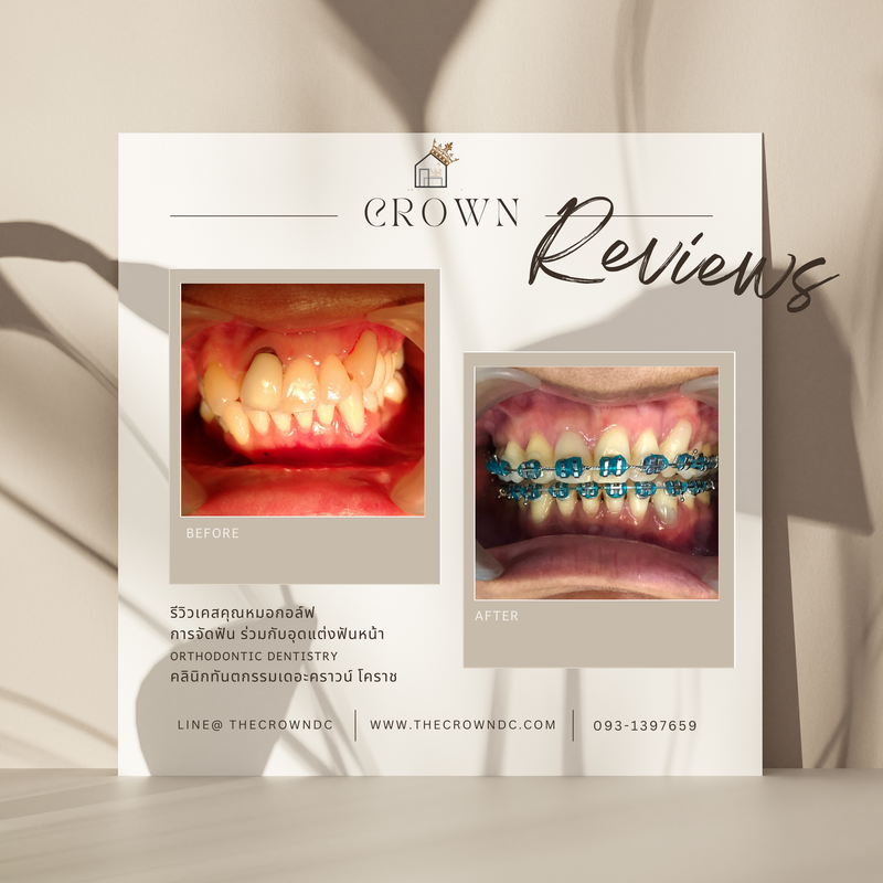 รีวิวการรักษาเคสจัดฟัน(บางส่วน)