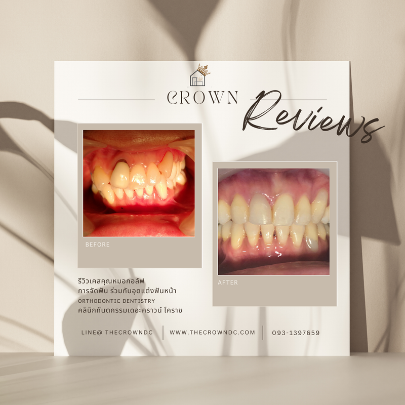 รีวิวการรักษาเคสจัดฟัน(บางส่วน)