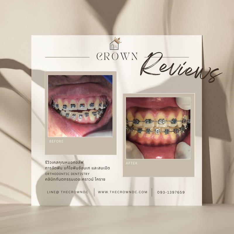 รีวิวการรักษาเคสจัดฟัน(บางส่วน)