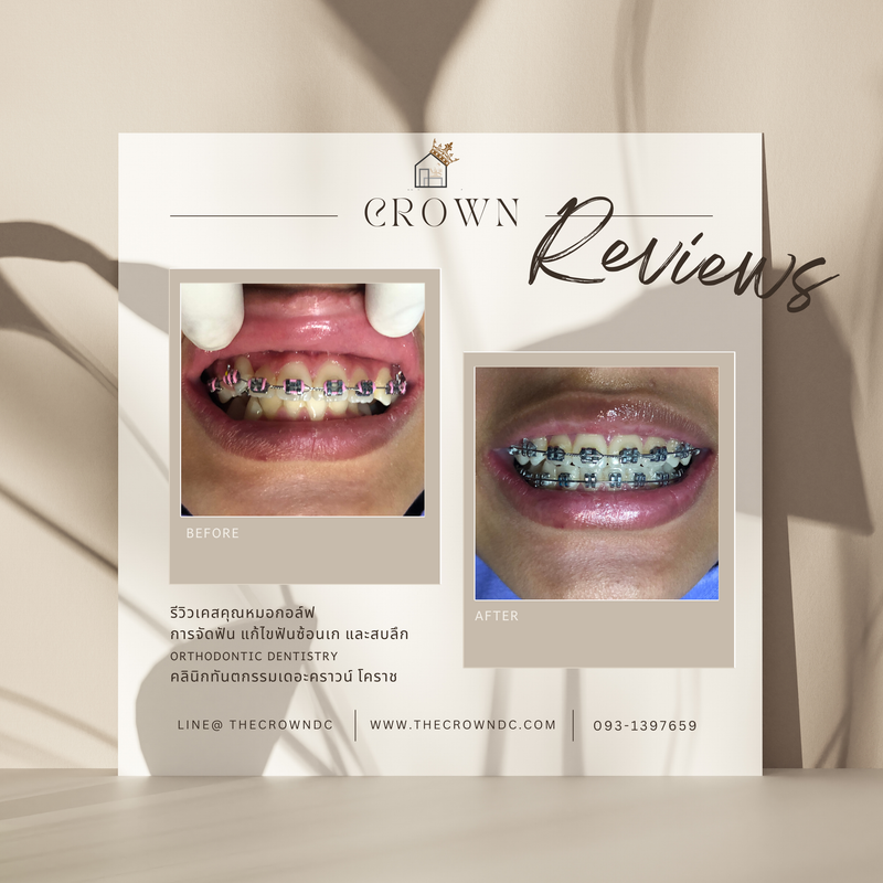 รีวิวการรักษาเคสจัดฟัน(บางส่วน)