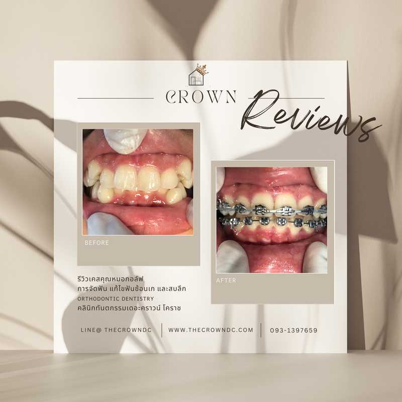 รีวิวการรักษาเคสจัดฟัน(บางส่วน)