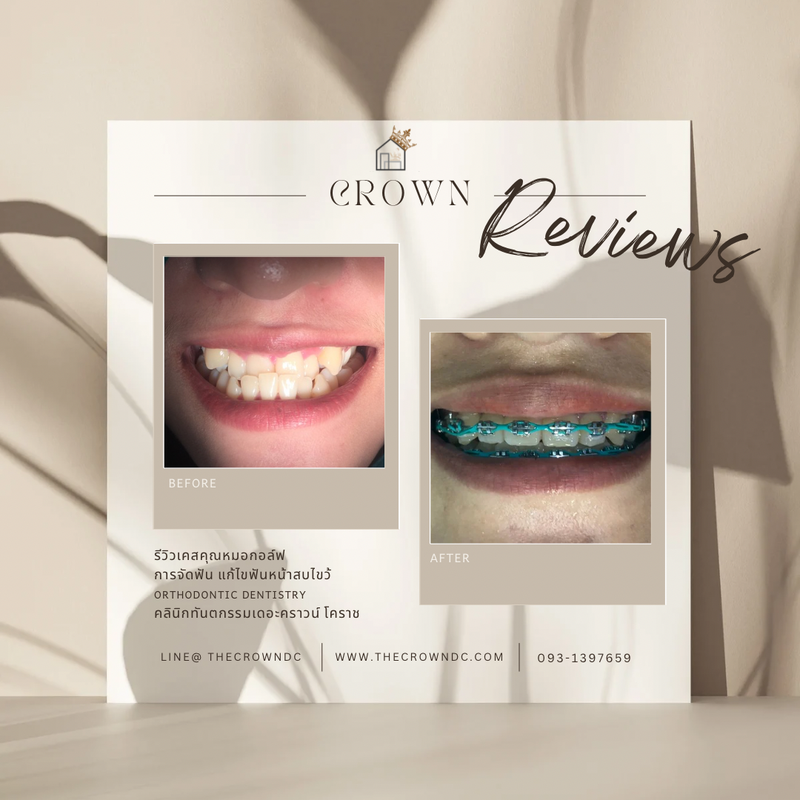 รีวิวการรักษาเคสจัดฟัน(บางส่วน)