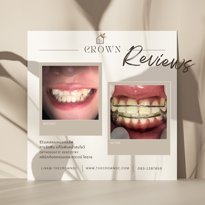 รีวิวการรักษาเคสจัดฟัน(บางส่วน)