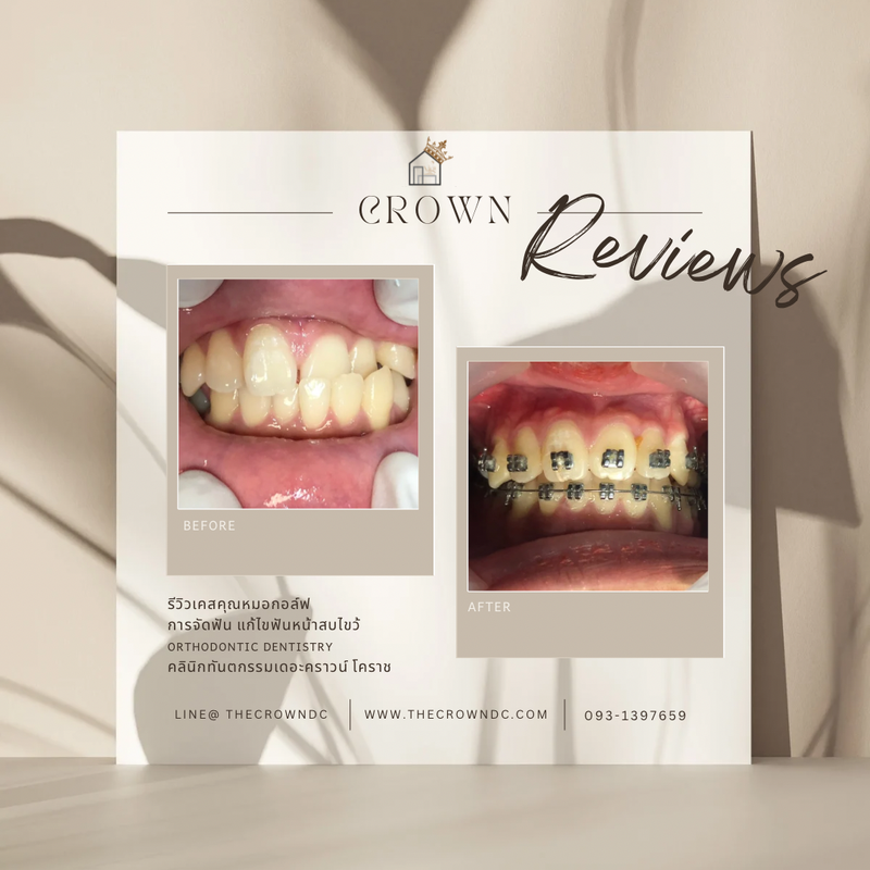 รีวิวการรักษาเคสจัดฟัน(บางส่วน)