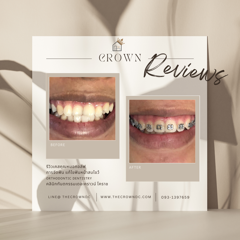 รีวิวการรักษาเคสจัดฟัน(บางส่วน)