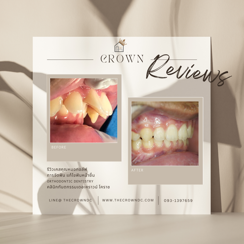 รีวิวการรักษาเคสจัดฟัน(บางส่วน)