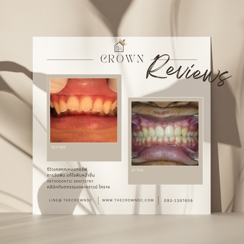 รีวิวการรักษาเคสจัดฟัน(บางส่วน)