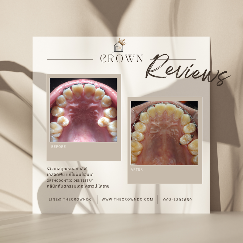 รีวิวการรักษาเคสจัดฟัน(บางส่วน)