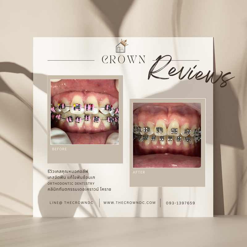 รีวิวการรักษาเคสจัดฟัน(บางส่วน)