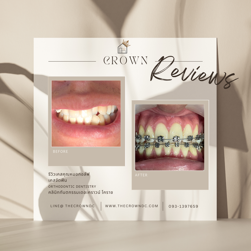 รีวิวการรักษาเคสจัดฟัน(บางส่วน)