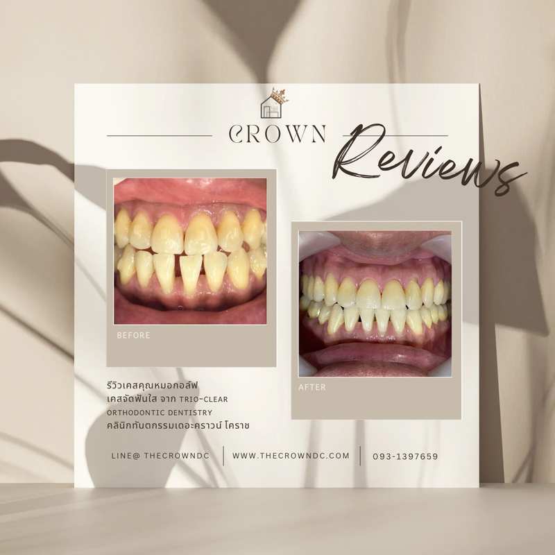 รีวิวการรักษาเคสจัดฟัน(บางส่วน)