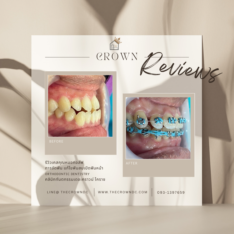 รีวิวการรักษาเคสจัดฟัน(บางส่วน)