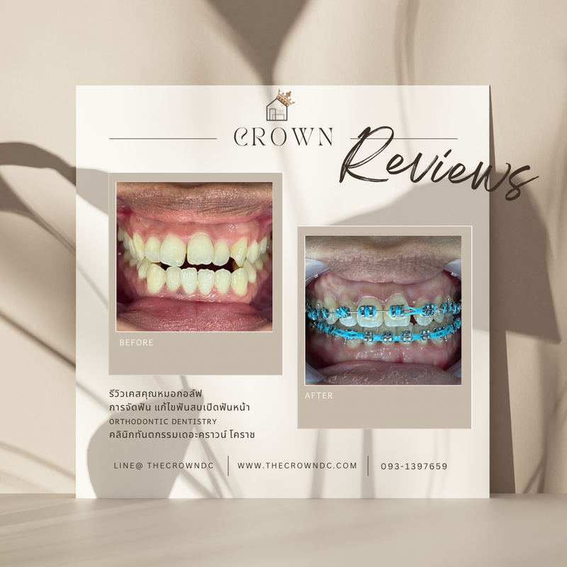 รีวิวการรักษาเคสจัดฟัน(บางส่วน)