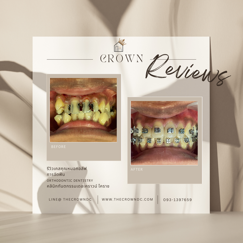 รีวิวการรักษาเคสจัดฟัน(บางส่วน)